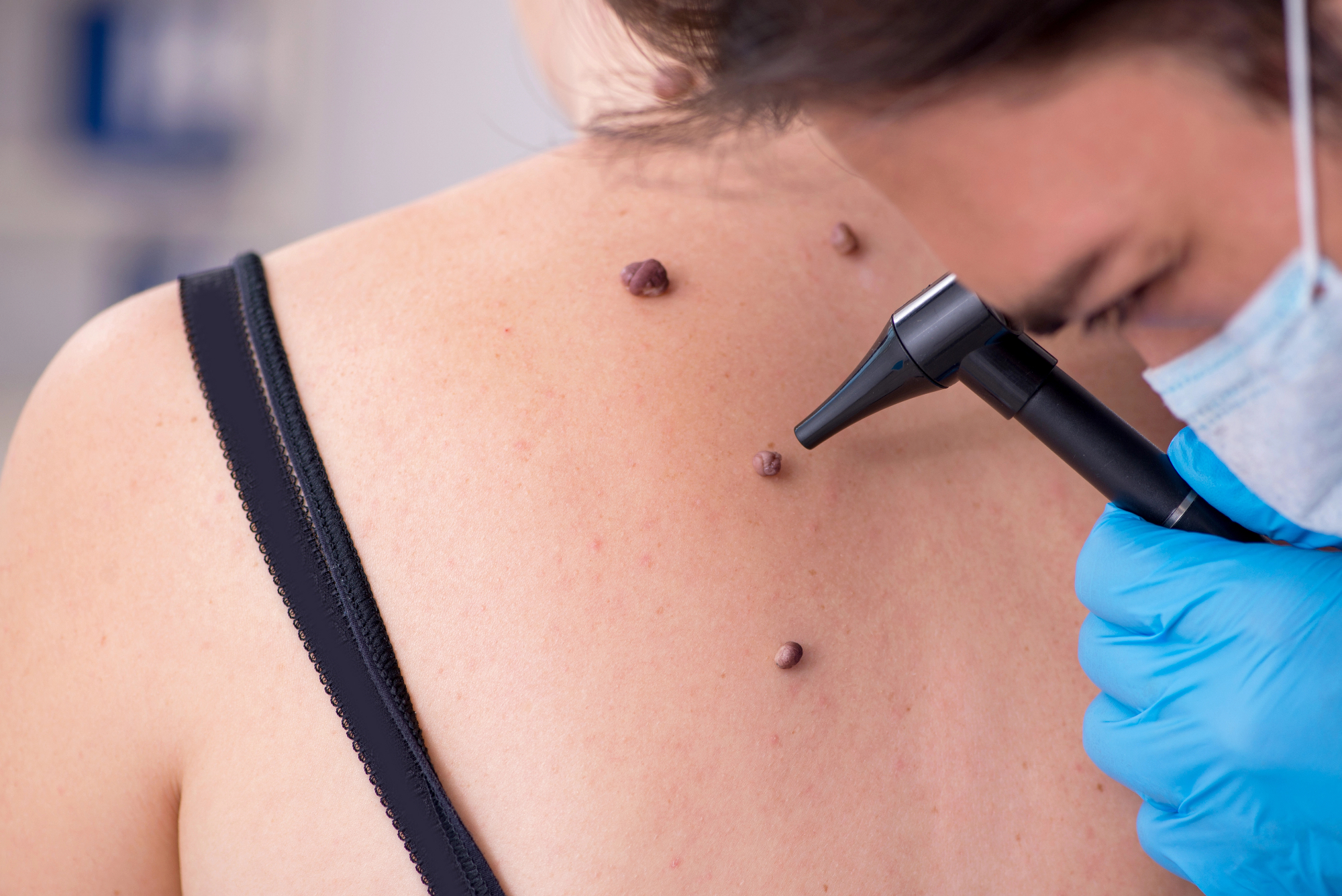 Preventivni pregled more opraviti dermatolog vsaj enkrat letno